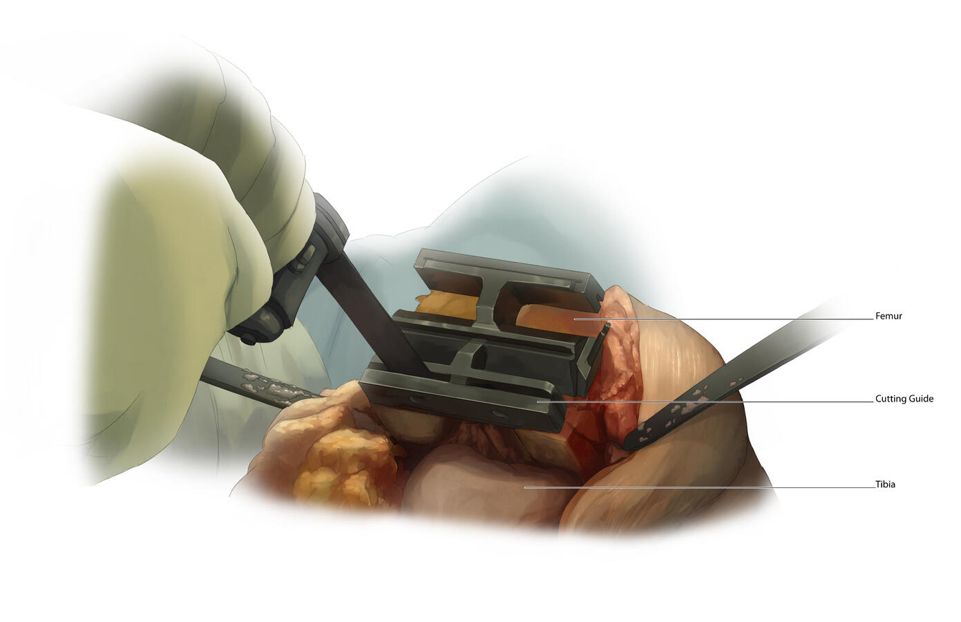 didactic knee surgery